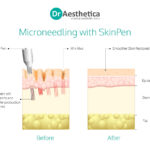 The Effects of Microneedling on Different Skin Types: Oily, Dry, Combination, and Sensitive