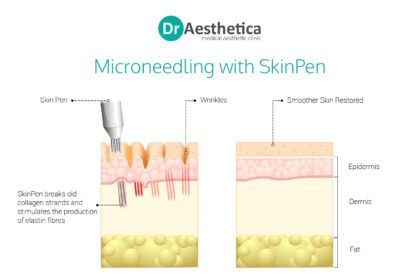 The Effects of Microneedling on Different Skin Types: Oily, Dry, Combination, and Sensitive