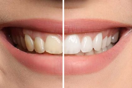 Teeth Whitening Over Dental Veneers