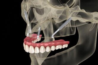 Zygomatic Dental Implant Treatment in Turkey