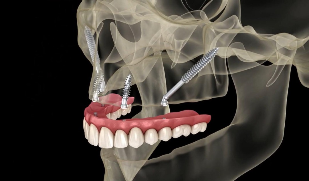 Zygomatic Dental Implant Treatment in Turkey